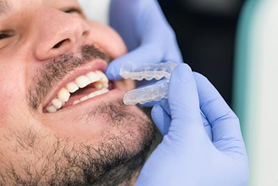 orthodontist putting invisalign clear aligners in patient's mouth